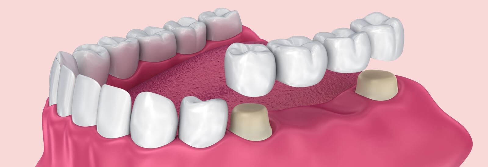 Dental Bridges