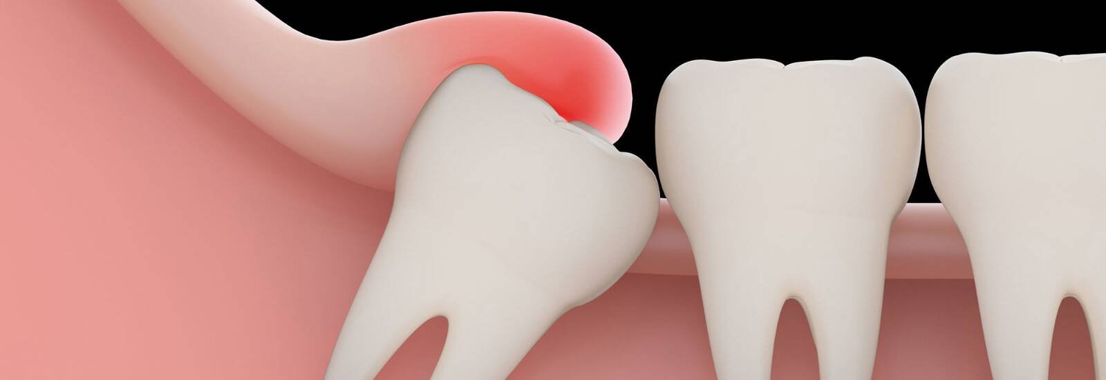 Impacted Wisdom Tooth