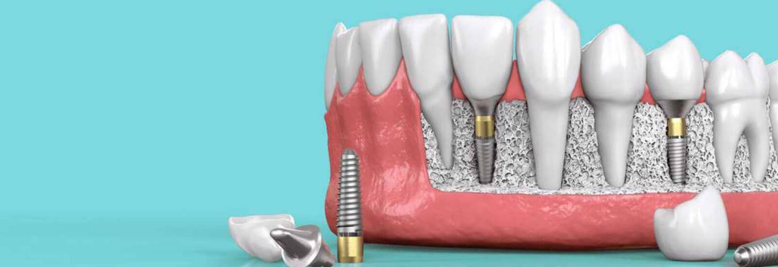 Dental Implants