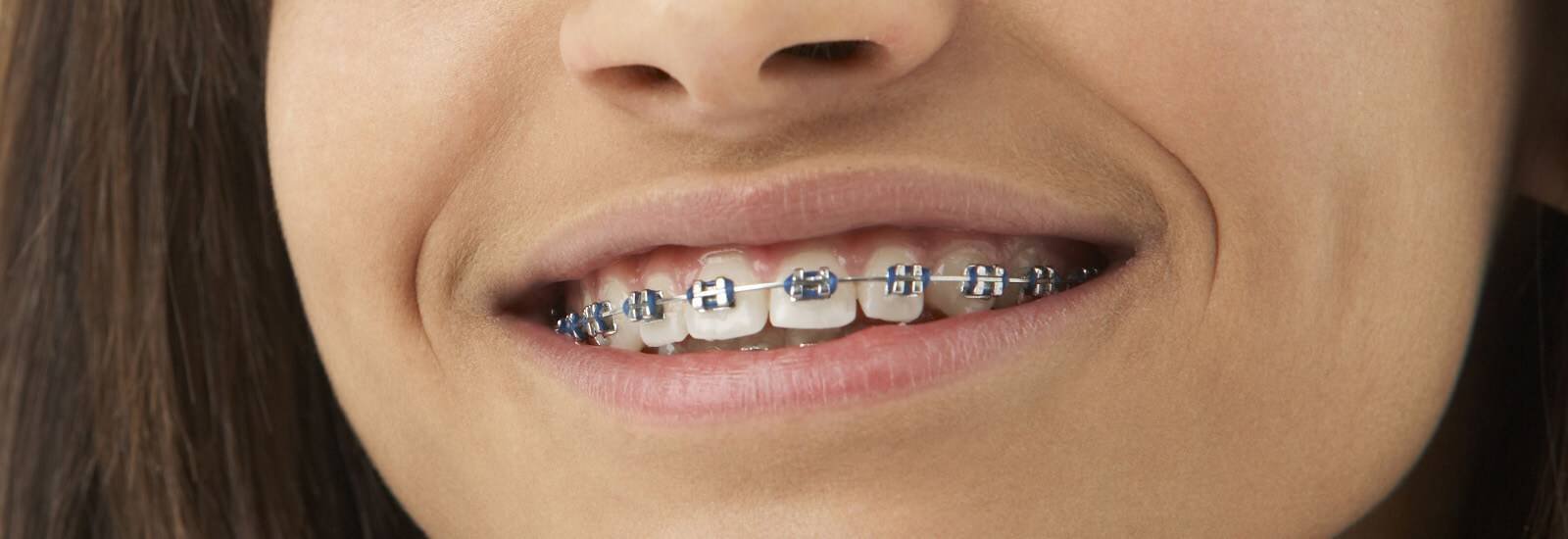 Dental Braces Treatment