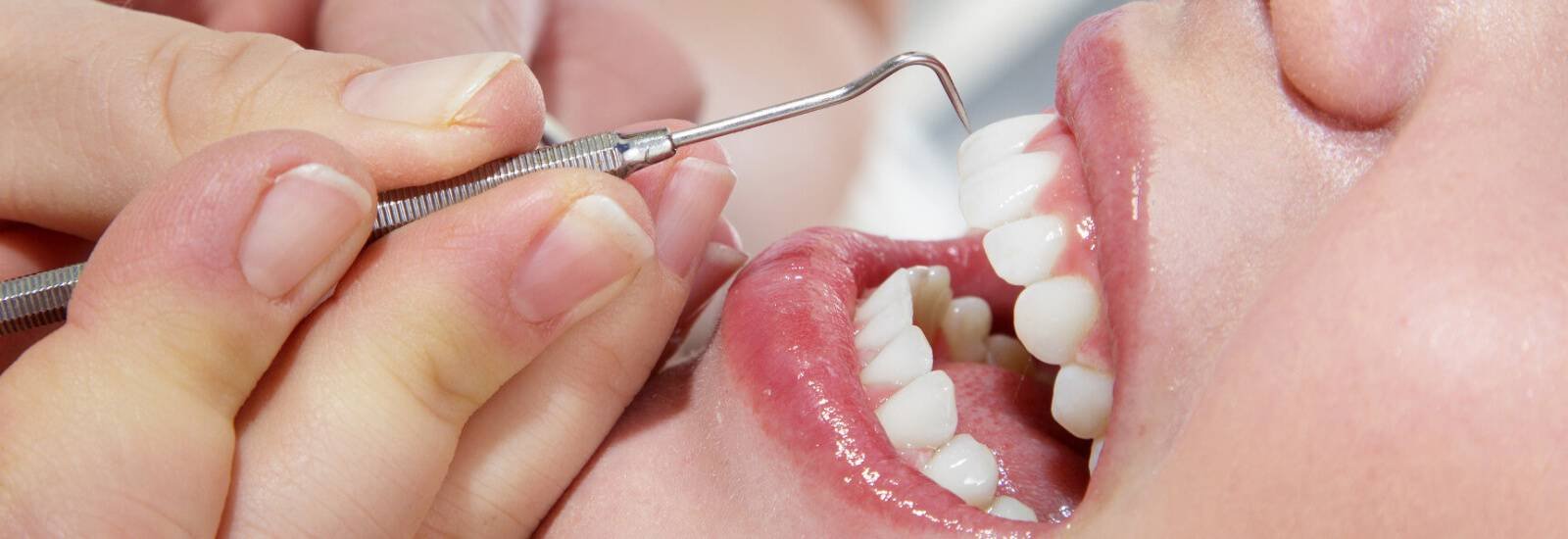 Teeth Cleaning and Polishing